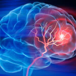 Trombosis y derrames cerebrales