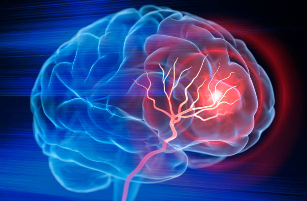 Trombosis y derrames cerebrales